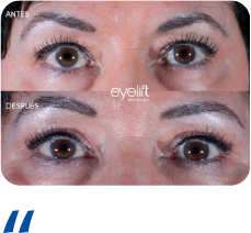 Blefaroplastia Recurso 10
