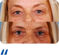 Blefaroplastia Recurso 12