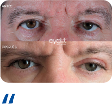 Blefaroplastia Recurso 13