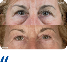 Blefaroplastia Recurso 14