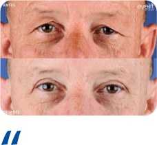 Blefaroplastia Recurso 15