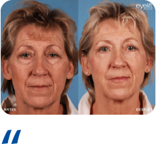 Blefaroplastia Recurso 16