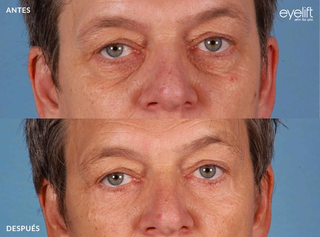 eyelift blefaroplastia inferior madrid 01