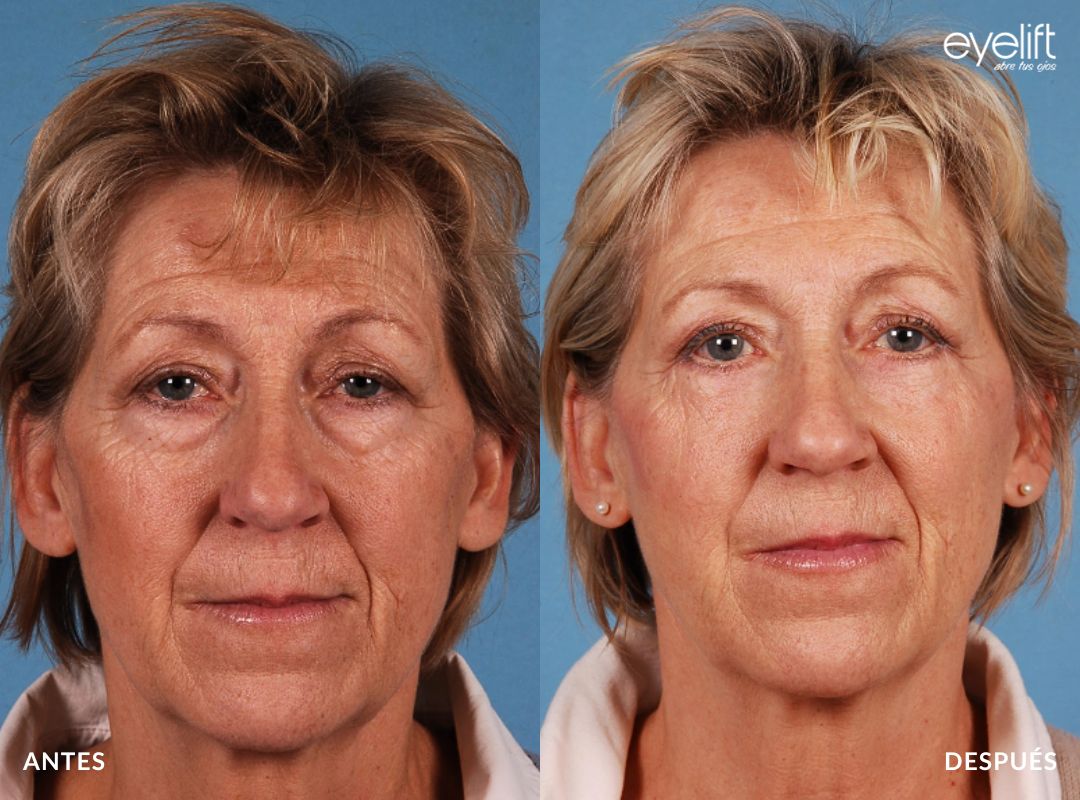 eyelift blefaroplastia inferior madrid 02