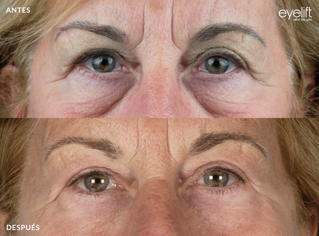 eyelift blefaroplastia inferior madrid 03