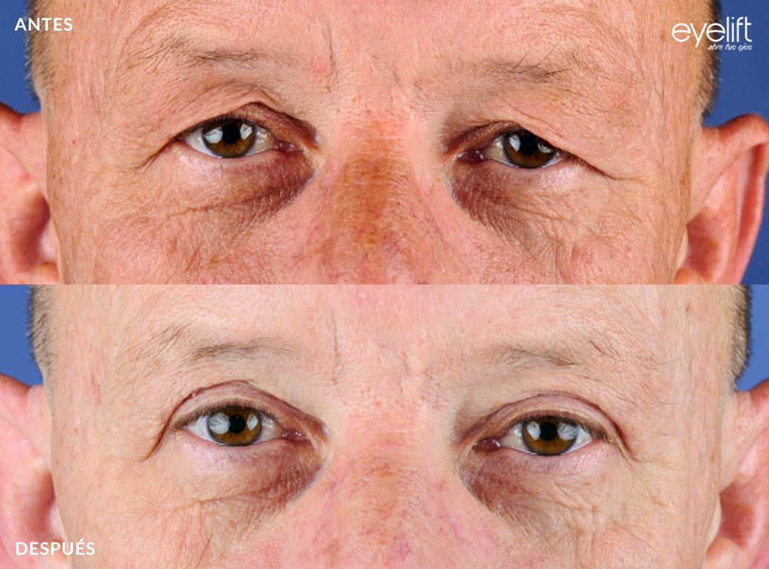 eyelift blefaroplastia superior madrid 04