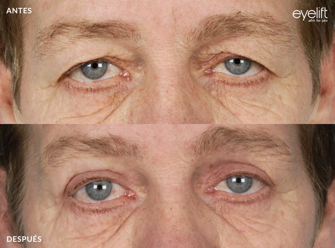 eyelift blefaroplastia superior madrid 06