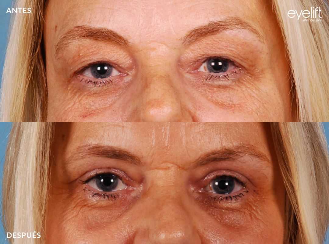 eyelift lifting cejas madrid 02